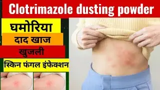 clotrimazole dusting powder Review//clotrimazole powder benefits in Hindi