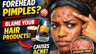 Forehead Pimples? Your Hair Products Are Secretly Causing Your Acne