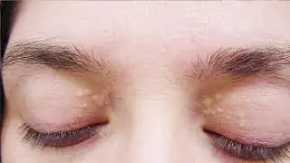 how to get rid of cholesterol deposits on upper eyelid