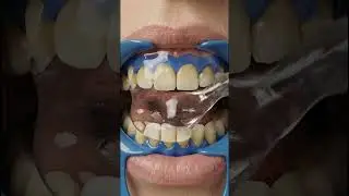 Satisfying Teeth Whitening ASMR 🤤