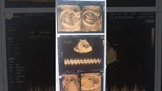 🤱5th month anomaly scan report in tamil#newborn #anomalyscan #5thmonthpregnency #gender