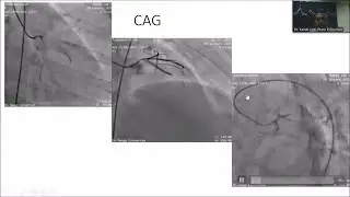 Intervention Presentation (Coronary Artery Spasm)