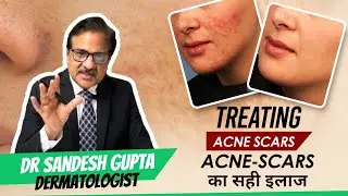 How to remove Acne, Burn & Accident Scars || Laser Removal |  #skincare #haircare #acne #acnescars