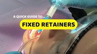Fixed retainers | Keeping teeth straight after braces