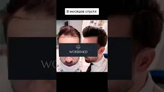 Пересадка волос в Турции | Результат после пересадки волос техникой FUE Sapphire