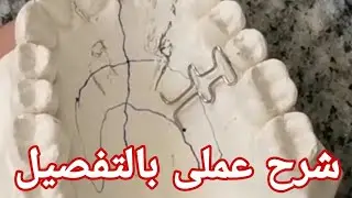 Orthodontics T_Spring