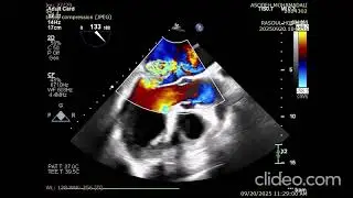 کیس اندوکاردیت بر روی PMVL, مورد دیالیز. کاندید urgency MVR