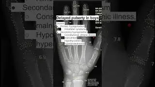 Delayed puberty in boys