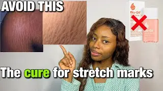 NO MORE STRETCH MARKS | How to treat stretch marks | Does Bio Oil work ?