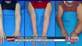 Living with Lymphedema