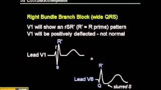 12-15 Lead ECG: Right Bundle Branch Block