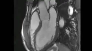 Cardiac MRI 3 chamber view