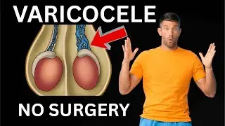 Varicocele Ka ilaj | Without Surgery Kya Hai | Alamat Wajuhat Medicines | Pain Swelling Test Urdu