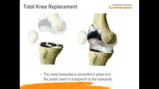 Knee Pain - Dr. Robert Daley, Silver Cross Hospital