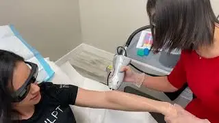 Arms Laser Hair Removal with Candela GentleMax Pro