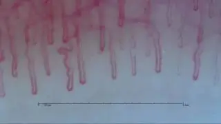 Nailfold Capillary image captured by Smart G-Scope(Woman 2)