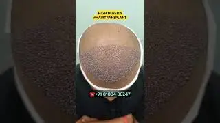 Hair Loss Treatment #hair #hairloss #hairlosstreatment #ytshorts #alopecia #hairtransplant #hairfall