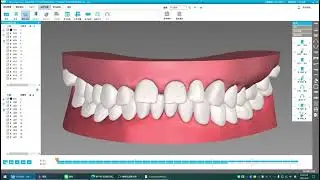 Invisible Braces｜Orthodontic Treatment Planning｜Protruding Teeth & Gap Correction