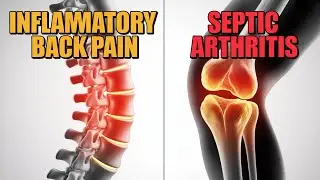 #Inflammatory Back Pain vs Septic Arthritis | Which Case Is Which?