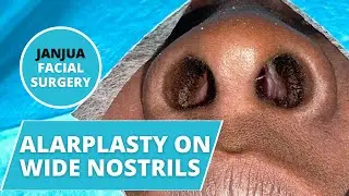 ALAR BASE REDUCTION (ALARPLASTY) ON WIDE NOSTRILS - DR. TANVEER JANJUA - NEW JERSEY