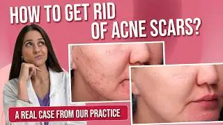 Scars after acne: best acne marks treatment