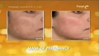 Fraxel Laser Reviews | Fraxel Restore | Fraxel Repair by Dr Gerrish