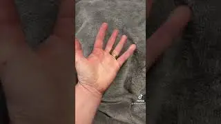 Can you touch your index finger to your pinky?