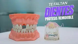 Como hacer protesis dental removible provisional con acrilico
