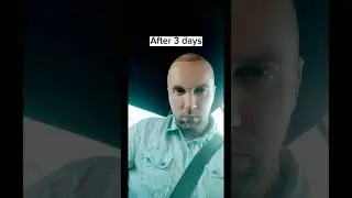 Hair Transplantation ● 8 months #hairtransplant #transformation