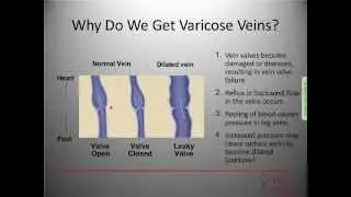 Rocky Mountain Vein Clinic Online Webinar - 01/18/2011
