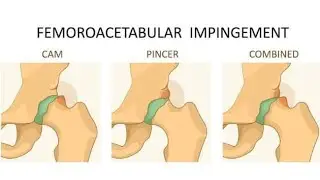 Femoro Acetabular Impingement ; abnormal contact between bones of hip joint causes pain, limits move