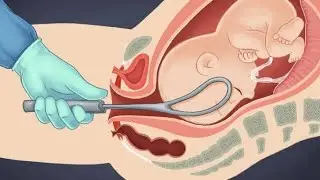 OUTLET FORCEPS DELIVERY (# LEARN THE RIGHT WAY)