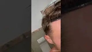 Dr.Kaan Pekiner 1340 grafts FUE - 5 years result