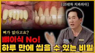 치아가 거의 없어도 하루만에 씹는다? 풀아치 임플란트 치료 사례