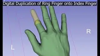 3D printing assisted Finger Prosthesis Fabrication
