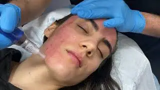 Microneedling using SkinPen and topical PRP for acne scars and skin rejuvenation by Dr. Shaun Patel