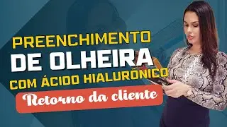 Preenchimento de Olheiras com Ácido Hialurônico - Harmonização Facial - Tratamento para olheiras