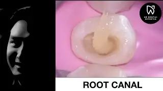 ROOT CANAL TREATMENT | DENTISTRY | DR RIZAL RIZKY AKBAR