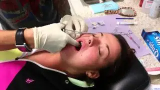 My Friend Renee's double cheek piercing