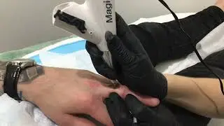 Tattoo Removal Using Magic Pen
