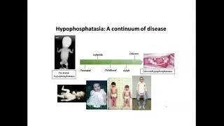 HPP Genetics Bootcamp: Learning More About ALPL Gene Changes and HPP in Families
