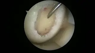 HealthWatch: Transplanting Fat Cells - Relieving Knee Pain