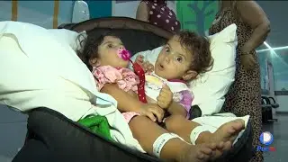 GÊMEAS SIAMESAS VÃO PASSAR POR CIRURGIA DE SEPARAÇÃO NO HECAD