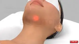 Endolift Facial Shaping Luminosa Medical Spa in Phoenix, Arizona