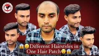 Hair fixing for men in bangalore Non surgical hair replacement for men Hair patches for men