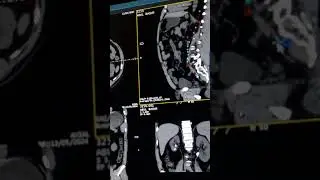 All Type of Ct-scan Ct-Non Contrast KUB with ureter tracking best way and esay