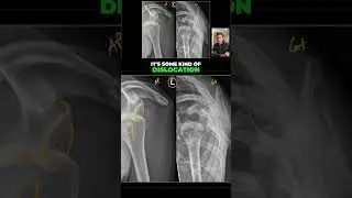 Случаи переднего и заднего вывиха плеча (часть 1)
