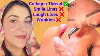 Collagen Silk Thread 🧵 For Removing Wrinkles/ Finelines / Laugh Lines