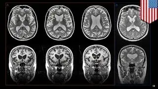 DDT exposure may increase Alzheimer's risk