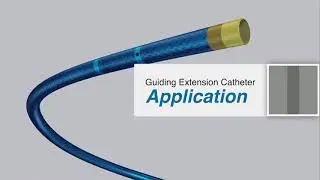 Guiding Extension catheter by Dr. Alexandre Quadros